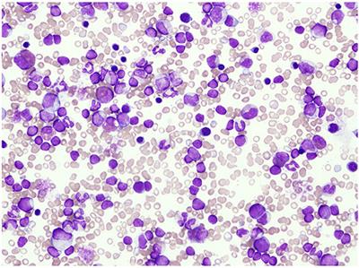 Case Report: Juvenile Myelomonocytic Leukemia Underlying Ornithine Transcarbamylase Deficiency Safely Treated Using Hematopoietic Stem Cell Transplantation